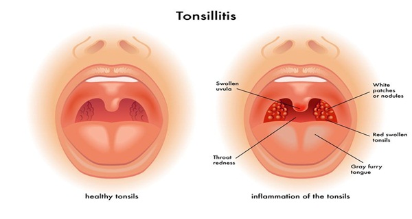 how to get rid of tonsil stones